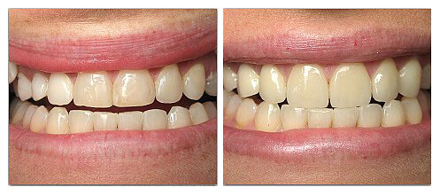 Porcelain Crowns