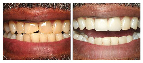Porcelain Veneers