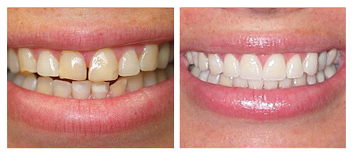 Smile Makeover